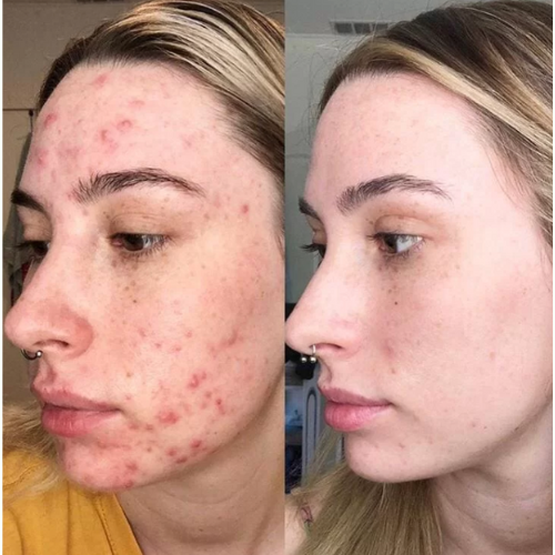 ¡EDICION LIMITADA 2x1 ! CLAYMASK™ - ELIMINA PUNTOS NEGROS Y REVIVE TU PIEL EN 15 MINUTOS