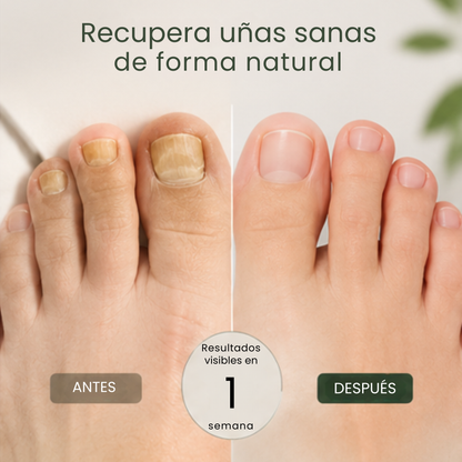 Tratamiento Anti-Hongos 7 Días 100% Natural